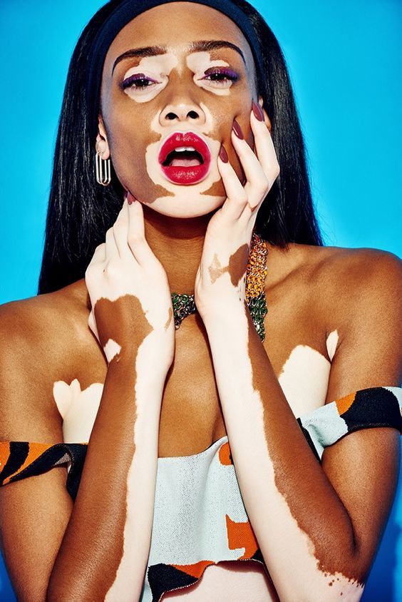 f56cbe36658a3d10d3de25d193bf3f10--winnie-harlow-pigmentation